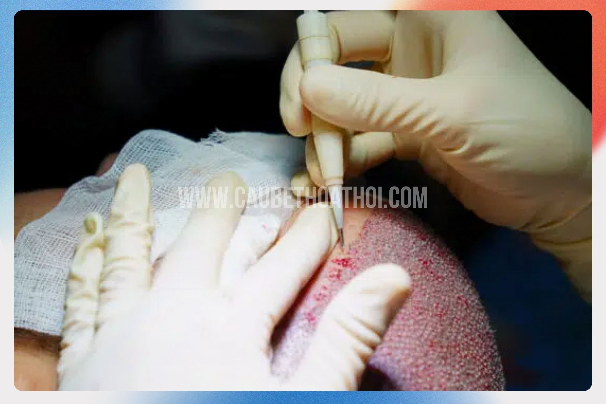 cấy tóc tự thân công nghệ kỹ thuật DHI