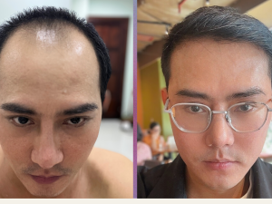 Hành Trình Cấy Tóc Tự Thân Phiên 1 (2000 Nang)