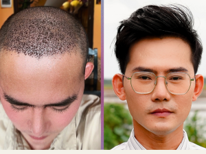 Hành Trình Cấy Tóc Tự Thân Phiên 2 (3100 Nang)