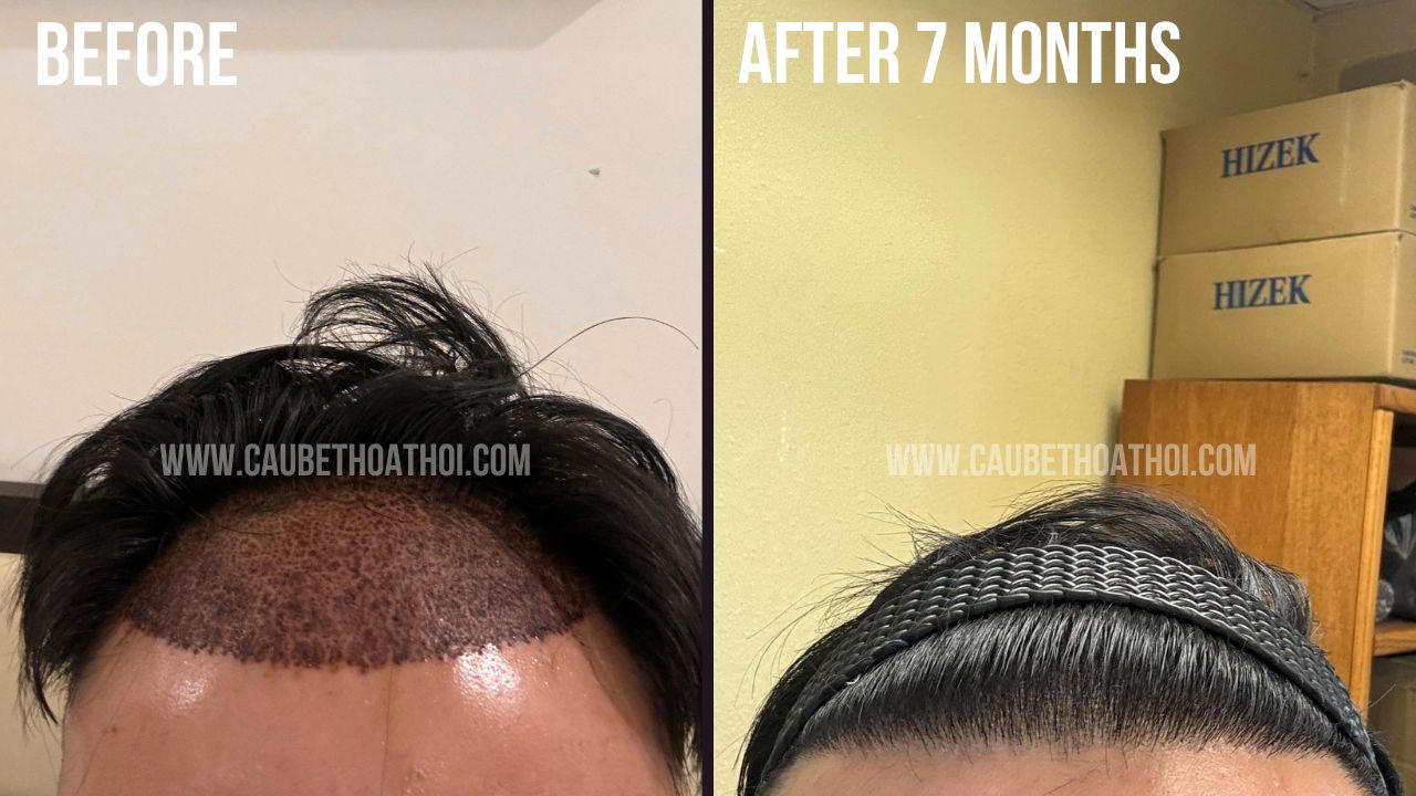 KẾT QUẢ SAU CẤY TÓC TỰ THÂN THÀNH CÔNG 7 THÁNG CỦA N.T