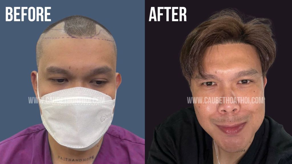 trương thanh bình sau cấy tóc chữa hói thành công