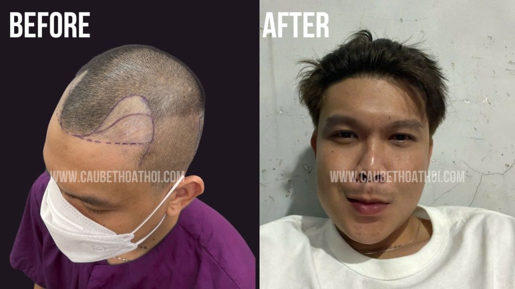 trương thanh bình sau cấy tóc chữa hói thành công