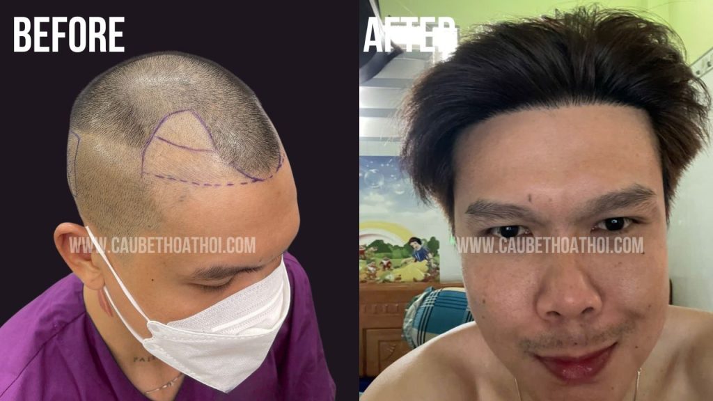 trương thanh bình sau cấy tóc chữa hói thành công