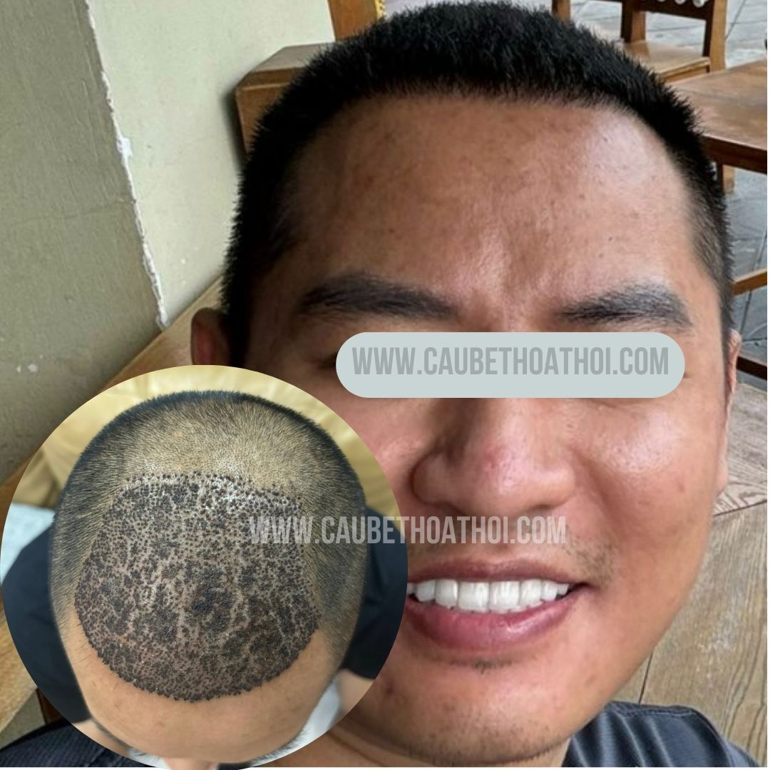 HÙNG ANH ĐÀO CẤY TÓC TỰ THÂN CHỮA HÓI ĐẦU - CẬU BÉ THOÁT HÓI