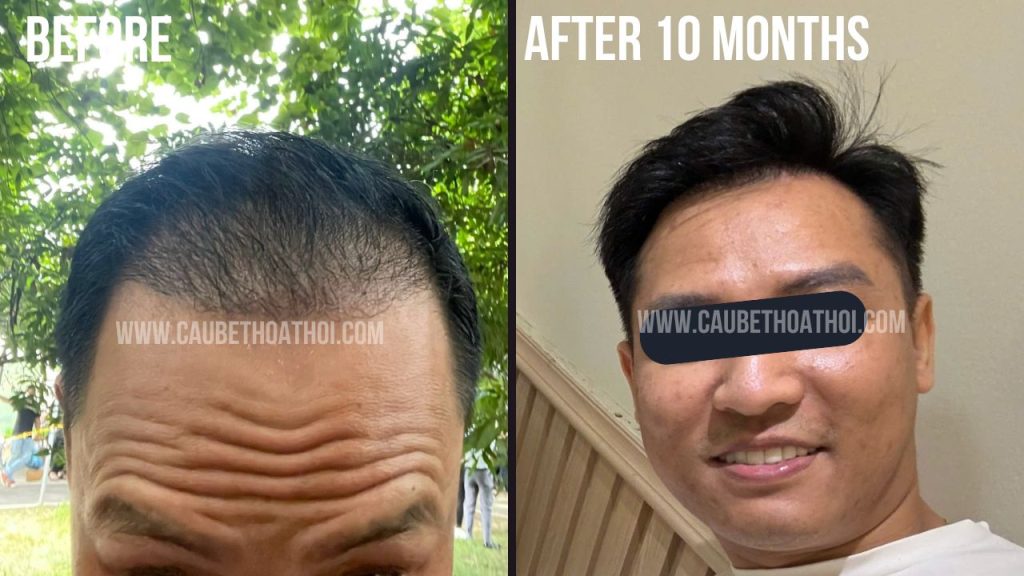 HÙNG ANH ĐÀO SAU CẤY TÓC TRỊ HÓI THÀNH CÔNG CÙNG CẬU BÉ THOÁT HÓI