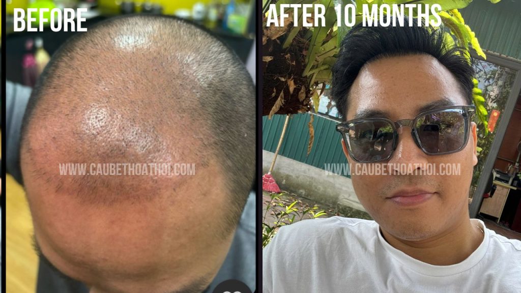 HÙNG ANH ĐÀO SAU CẤY TÓC TRỊ HÓI THÀNH CÔNG CÙNG CẬU BÉ THOÁT HÓI