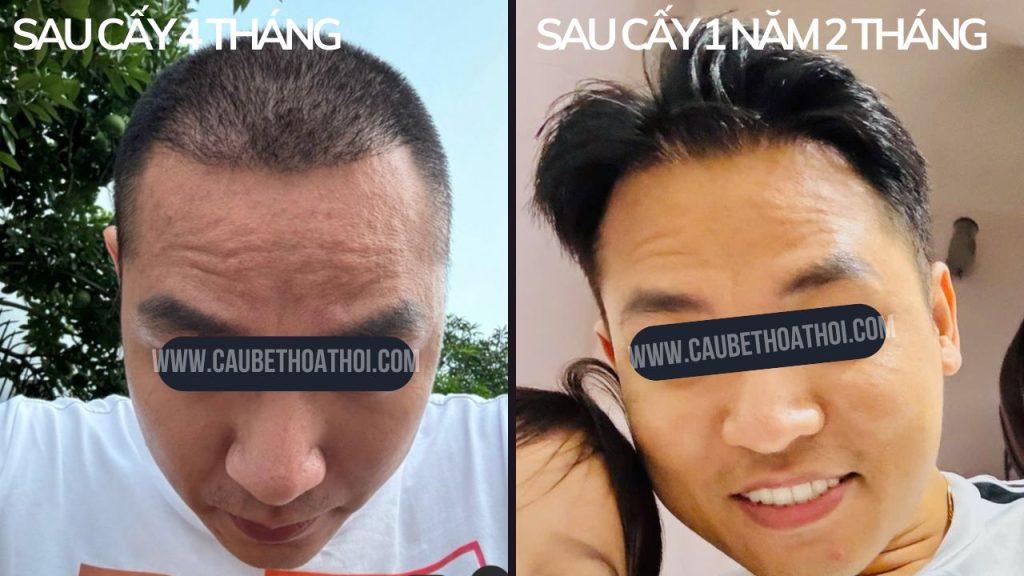 HÙNG ANH ĐÀO SAU CẤY TÓC TRỊ HÓI THÀNH CÔNG CÙNG CẬU BÉ THOÁT HÓI