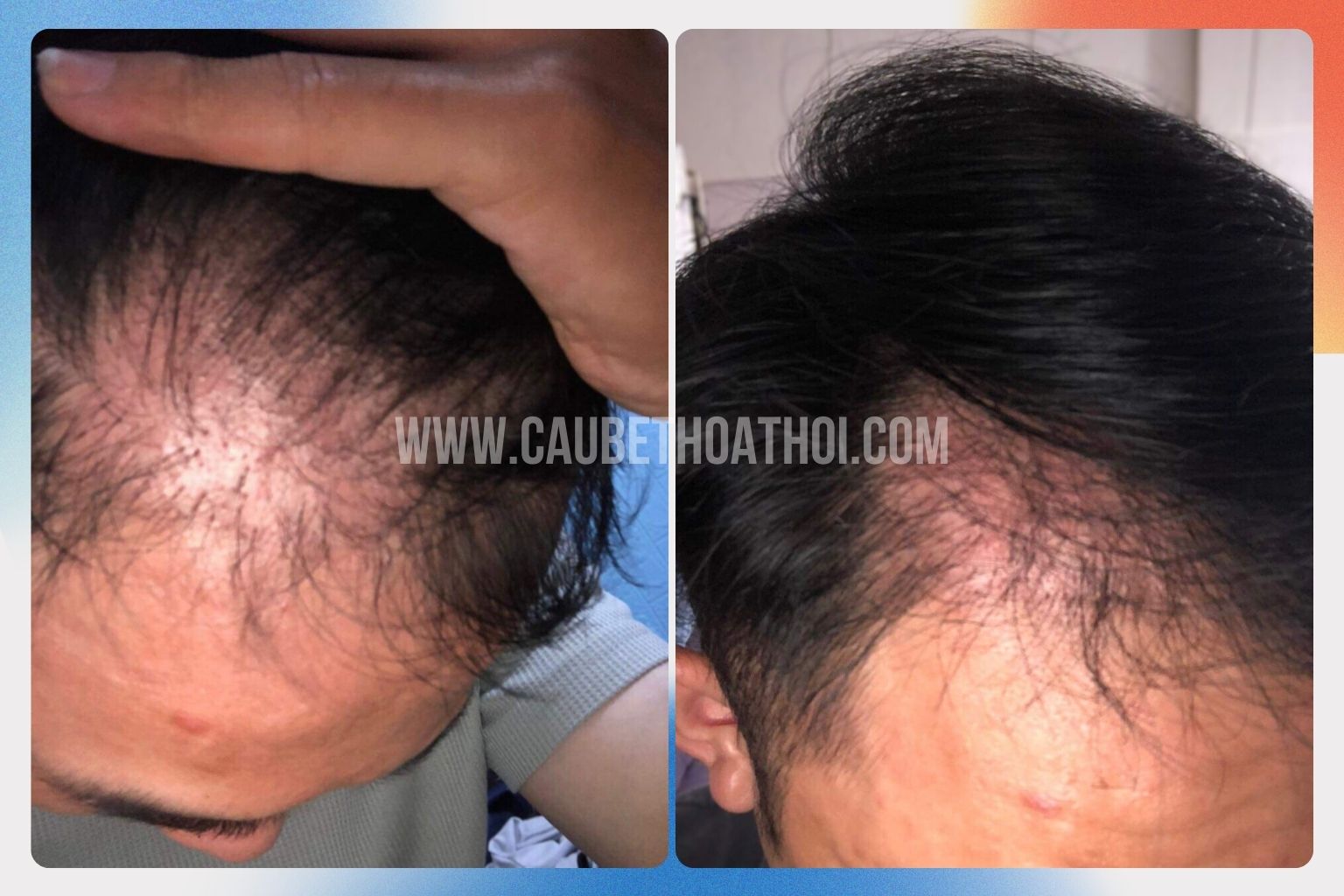 Hành trình cấy tóc chữ M với 2700 nang bị thất bại của đăng thịnh - cậu bé thoát hói