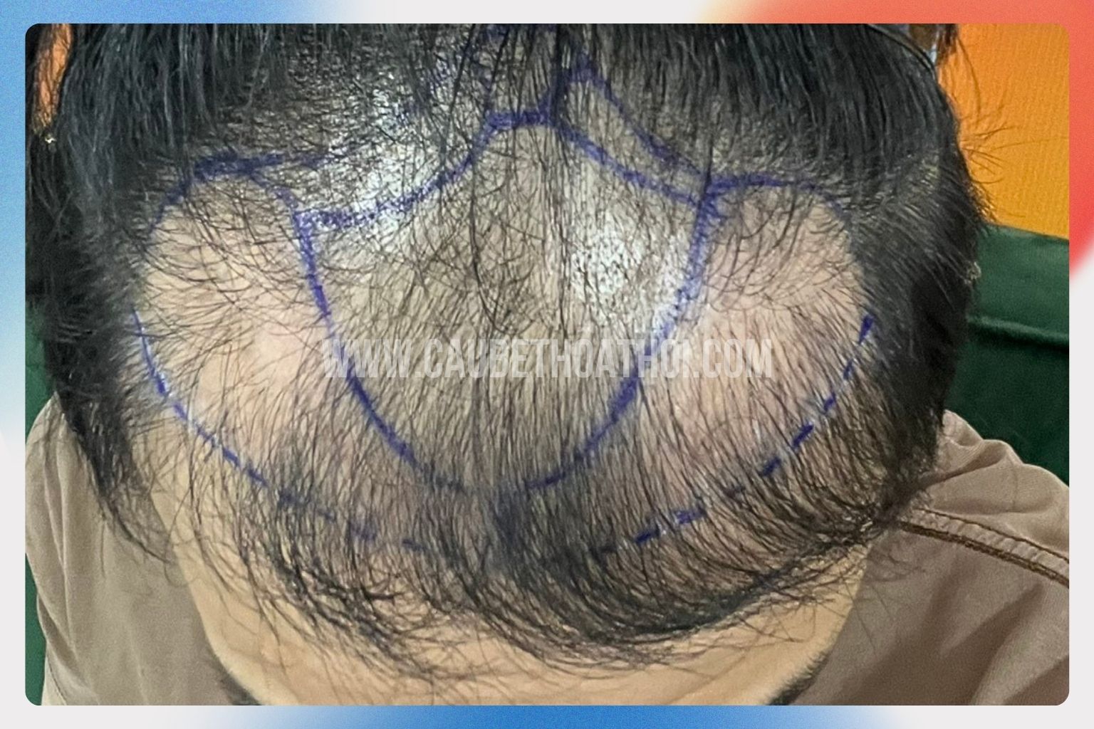 Hành trình cấy tóc chữ M với 2700 nang bị thất bại của đăng thịnh - cậu bé thoát hói 