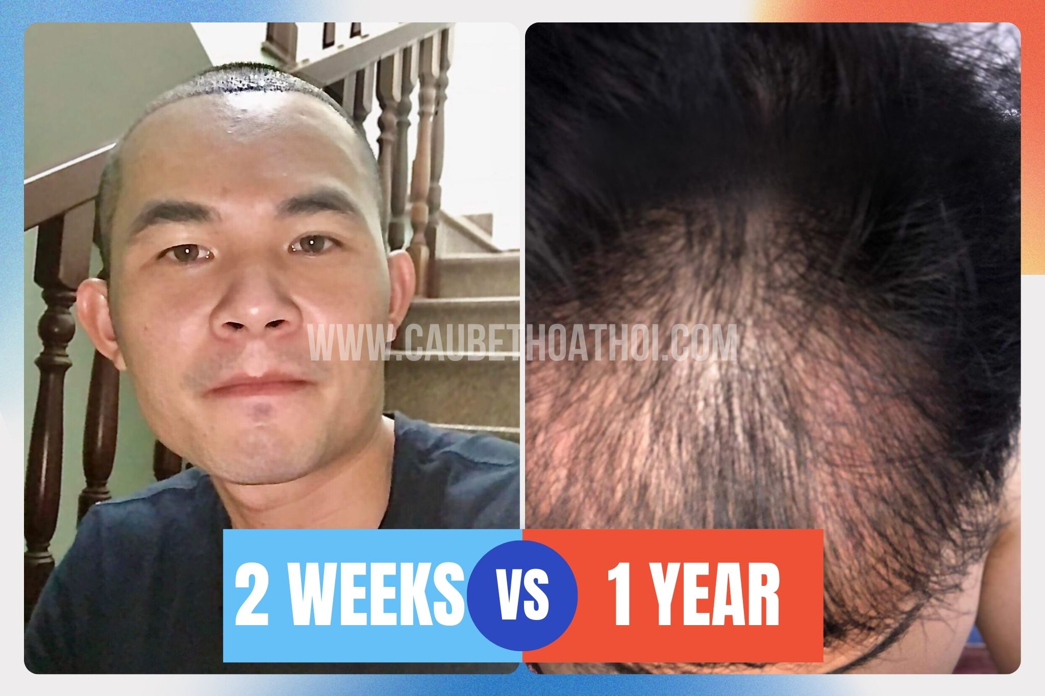 Hành trình cấy tóc chữ M với 2700 nang bị thất bại của đăng thịnh - cậu bé thoát hói