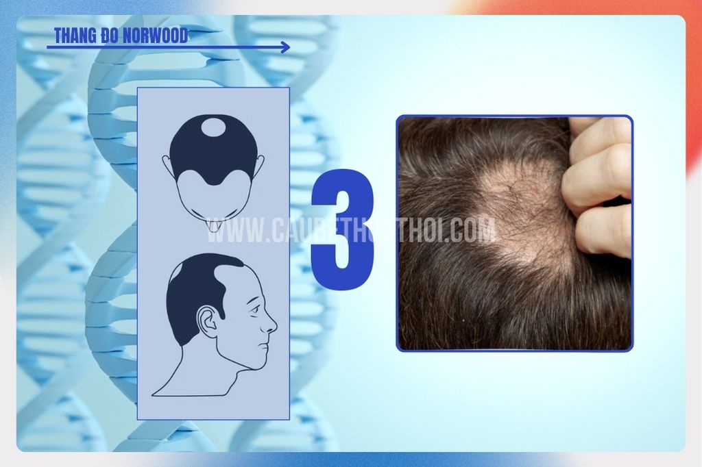 Hói đầu di truyền ở nam giới tiến triển như thế nào? cậu bé thoát hói 