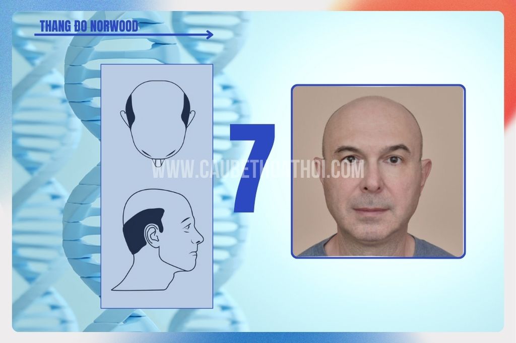 Hói đầu di truyền ở nam giới tiến triển như thế nào? cậu bé thoát hói 