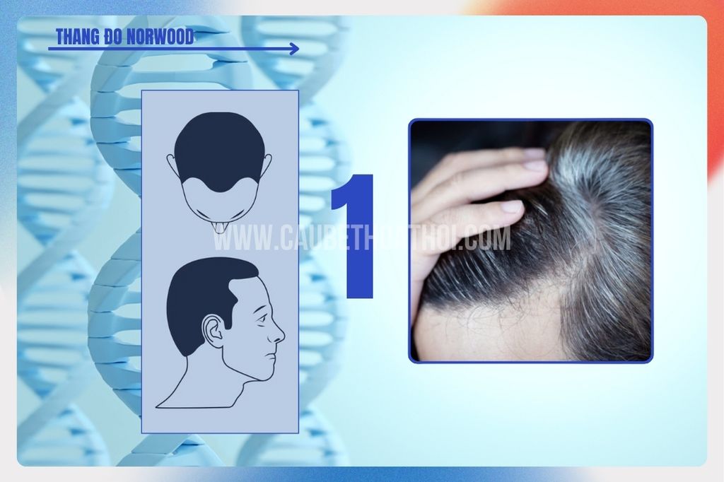 Hói đầu di truyền ở nam giới tiến triển như thế nào? cậu bé thoát hói