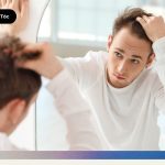 Hói đầu do di truyền Có phải nguyên nhân gen của bạn không