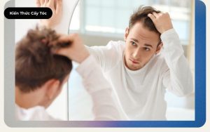 Hói đầu do di truyền Có phải nguyên nhân gen của bạn không