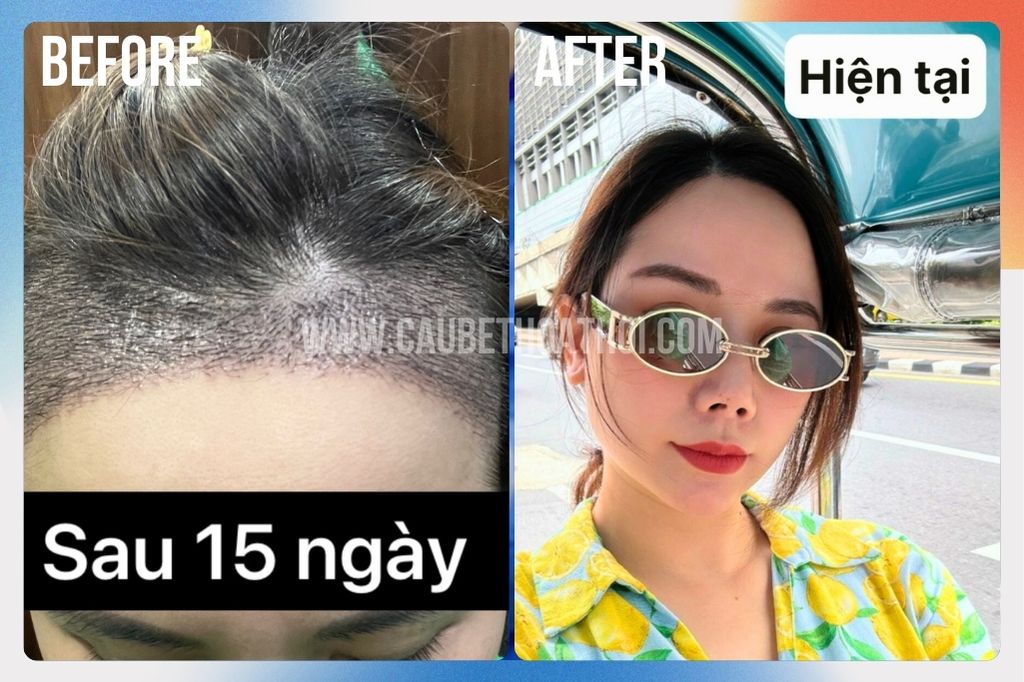 Kết quả sau cấy tóc DHI cho nữ giới thành công - cậu bé thoát hói