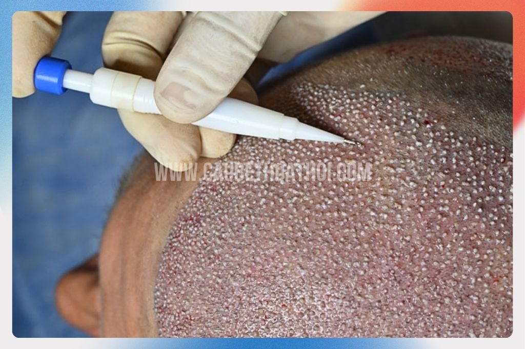 Kỹ thuật cấy tóc DHI cấy tóc trực tiếp - cậu bé thoát hói