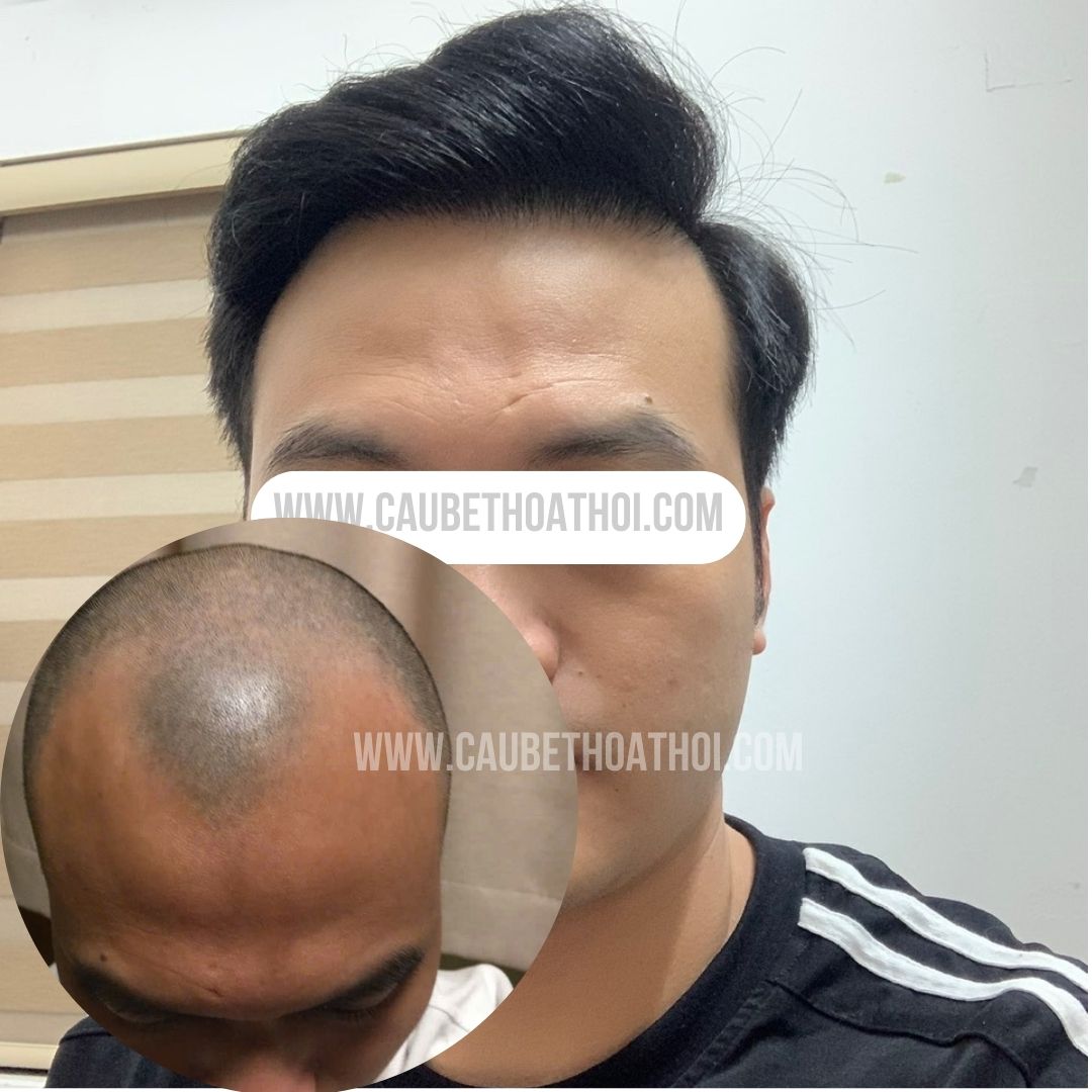 NGÔ QUANG HIỆP CẤY TÓC TỰ THÂN CHỮA HÓI ĐẦU M - CẬU BÉ THOÁT HÓI