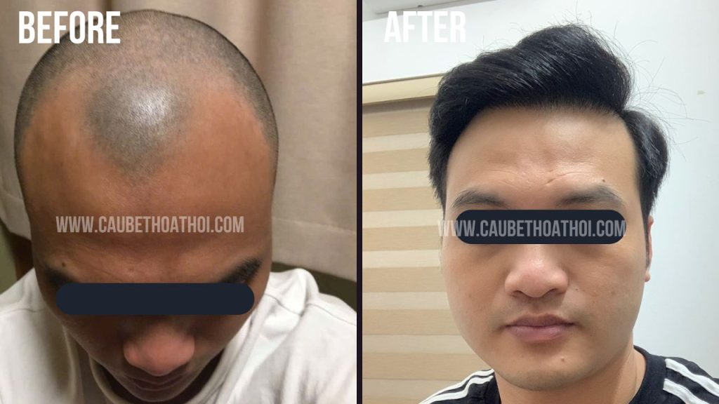 NGÔ QUANG HIỆP SAU CẤY TÓC TRỊ HÓI THÀNH CÔNG CÙNG CẬU BÉ THOÁT HÓI