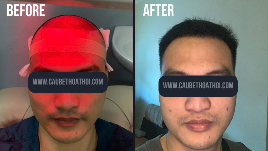 NGÔ QUANG HIỆP SAU CẤY TÓC TRỊ HÓI THÀNH CÔNG CÙNG CẬU BÉ THOÁT HÓI