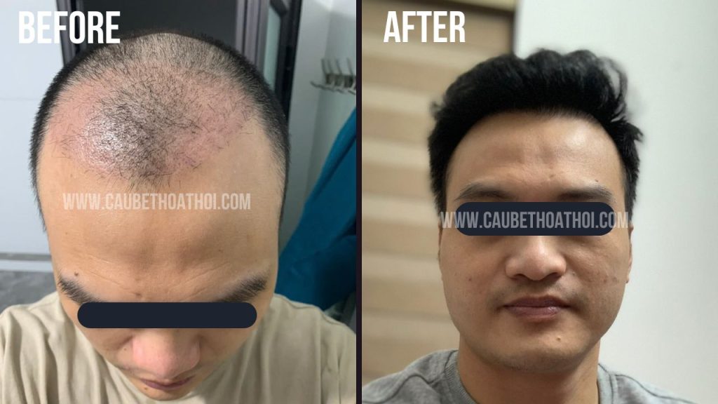 NGÔ QUANG HIỆP SAU CẤY TÓC TRỊ HÓI THÀNH CÔNG CÙNG CẬU BÉ THOÁT HÓI 2