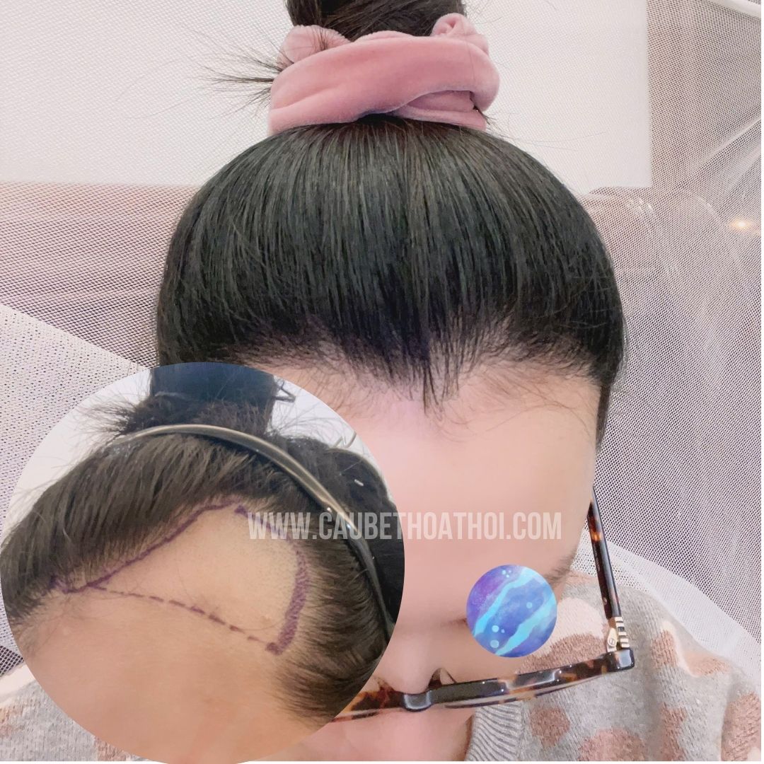 NGUYỄN HẰNG THANH CẤY TÓC NỮ BỊ BÒ LIẾM CHỮA HÓI ĐẦU - CẬU BÉ THOÁT HÓI