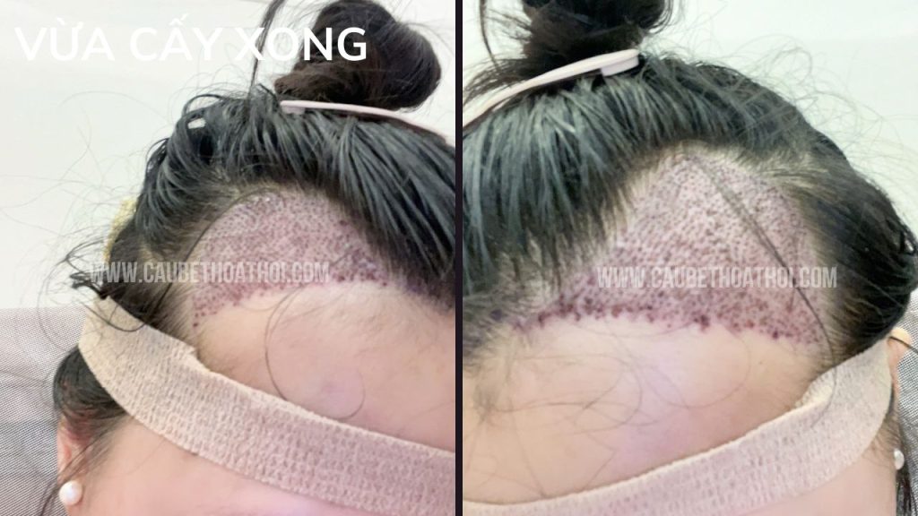 NGUYỄN HẰNG THANH KẾT QUẢ CẤY TÓC TRỊ BÒ LIẾM CHỮ M SAU 1 NĂM THÀNH CÔNG