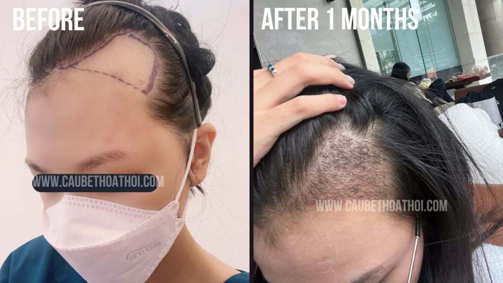 NGUYỄN HẰNG THANH KẾT QUẢ CẤY TÓC TRỊ BÒ LIẾM CHỮ M SAU 1 NĂM THÀNH CÔNG