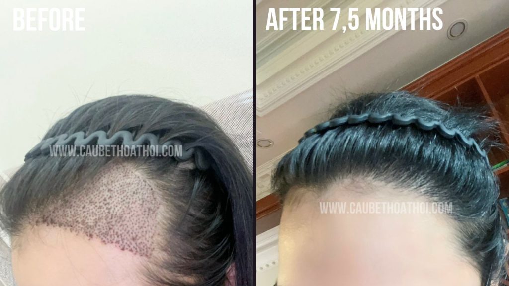 NGUYỄN HẰNG THANH KẾT QUẢ CẤY TÓC TRỊ BÒ LIẾM CHỮ M SAU 1 NĂM THÀNH CÔNG