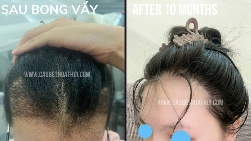 NGUYỄN HẰNG THANH KẾT QUẢ CẤY TÓC TRỊ BÒ LIẾM CHỮ M SAU 1 NĂM THÀNH CÔNG