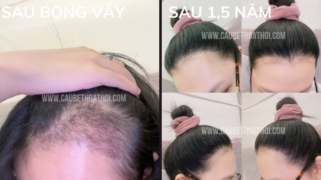 NGUYỄN HẰNG THANH KẾT QUẢ CẤY TÓC TRỊ BÒ LIẾM CHỮ M SAU 1 NĂM THÀNH CÔNG