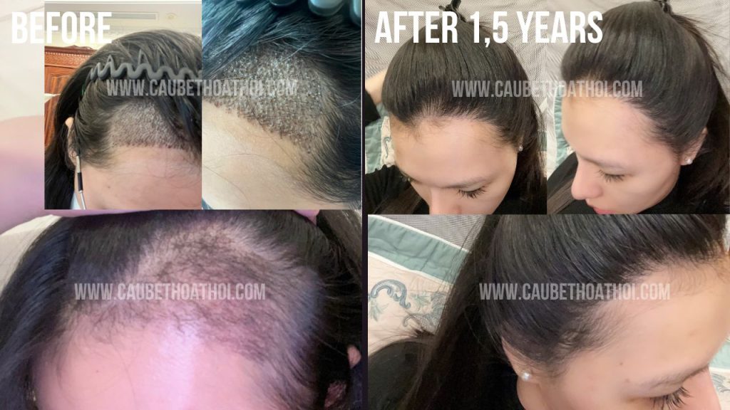 NGUYỄN HẰNG THANH KẾT QUẢ CẤY TÓC TRỊ BÒ LIẾM CHỮ M SAU 1 NĂM THÀNH CÔNG