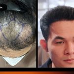 Review cấy tóc thất bại tại sài gòn của chàng trai xứ Huế và hành trình sửa lại chữ M - Cậu bé thoát hói