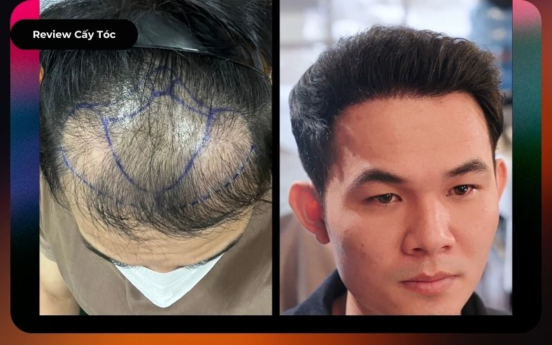 Review cấy tóc thất bại tại sài gòn của chàng trai xứ Huế và hành trình sửa lại chữ M - Cậu bé thoát hói