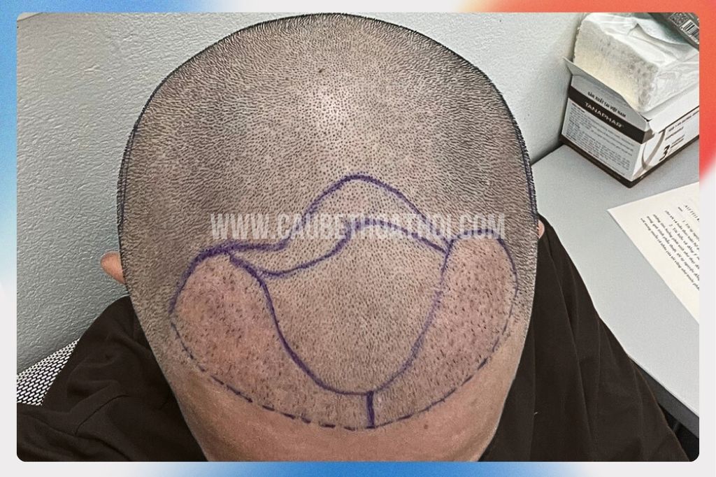 Review cấy tóc thất bại