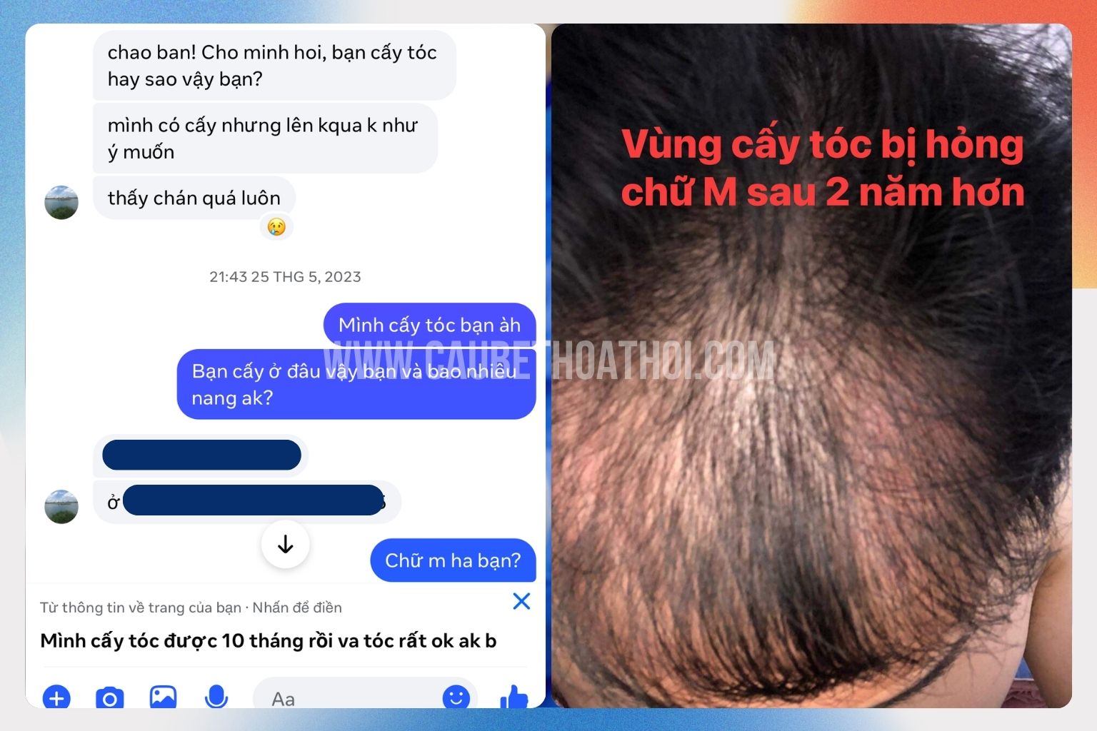 Review cấy tóc thất bại tại sài gòn của chàng trai xứ Huế và hành trình sửa lại chữ M- cậu bé thoát hói