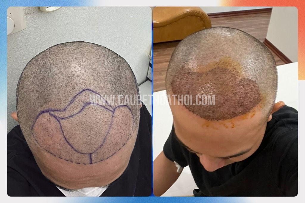 Review cấy tóc thất bại tại sài gòn của chàng trai xứ Huế và hành trình sửa lại chữ M- cậu bé thoát hói