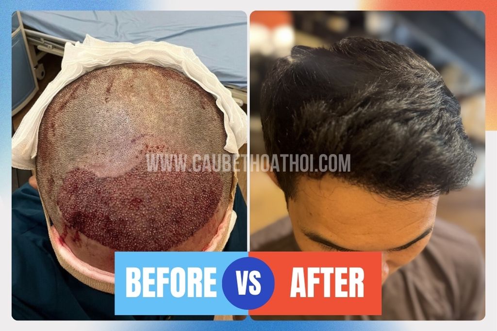 Review cấy tóc thất bại tại sài gòn của chàng trai xứ Huế và hành trình sửa lại chữ M- cậu bé thoát hói