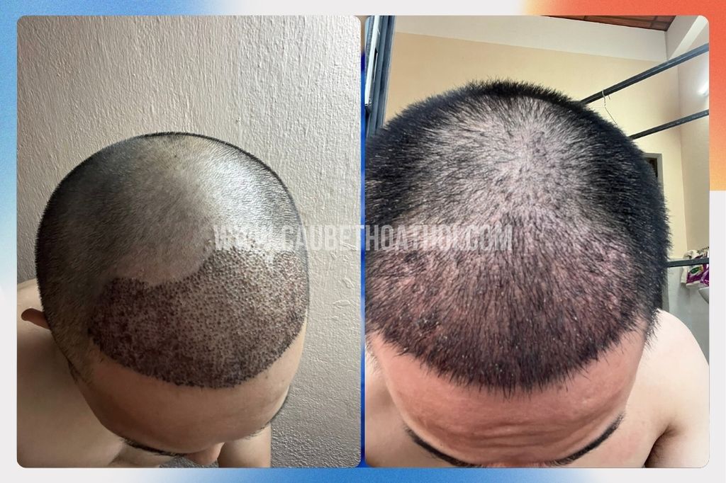 Review cấy tóc thất bại tại sài gòn của chàng trai xứ Huế và hành trình sửa lại chữ M- cậu bé thoát hói