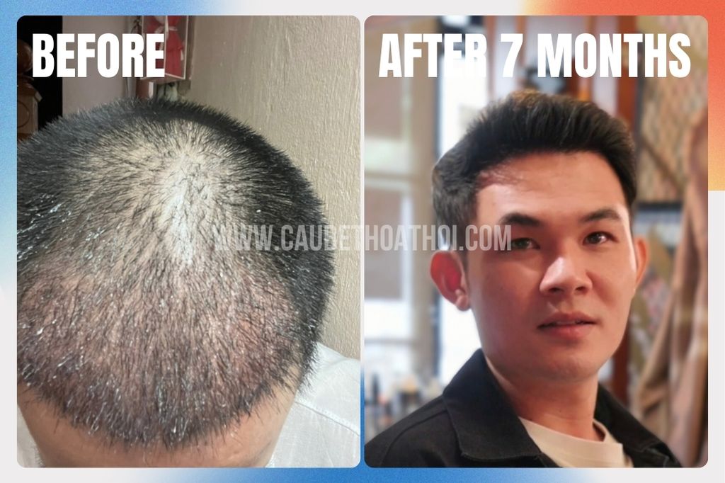 Review cấy tóc thất bại tại sài gòn của chàng trai xứ Huế và hành trình sửa lại chữ M- cậu bé thoát hói 