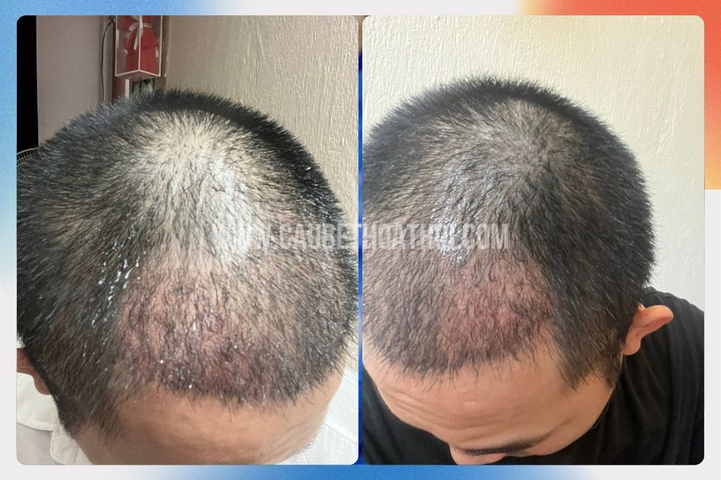 Review cấy tóc thất bại tại sài gòn của chàng trai xứ Huế và hành trình sửa lại chữ M- cậu bé thoát hói