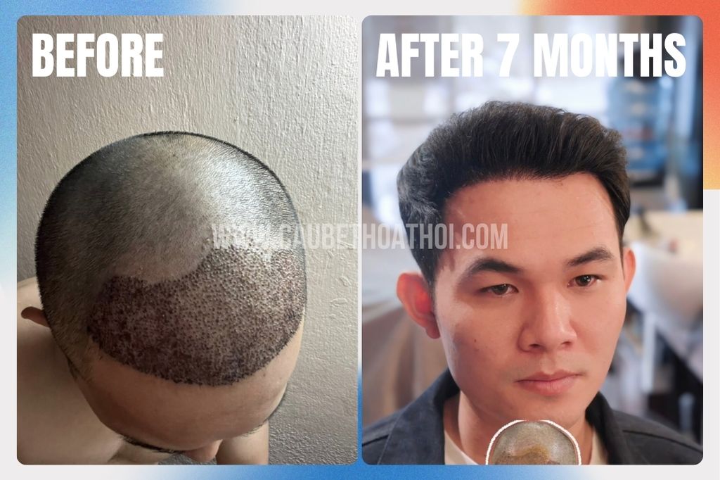 Review cấy tóc thất bại tại sài gòn của chàng trai xứ Huế và hành trình sửa lại chữ M- cậu bé thoát hói 