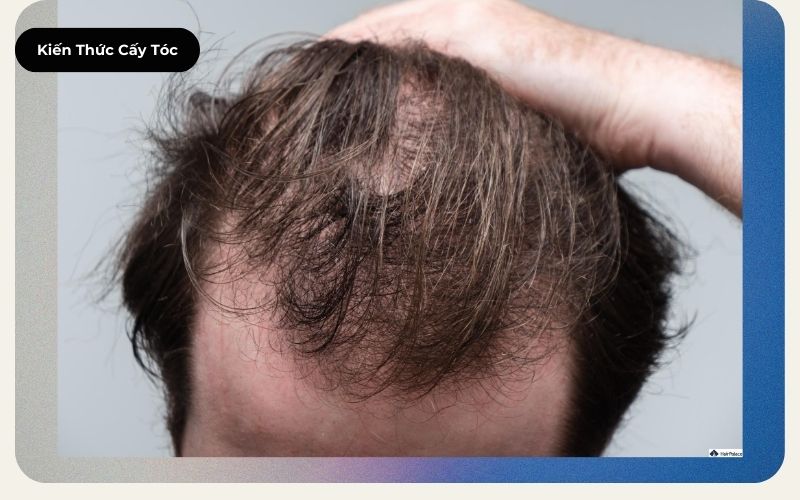 Rụng tóc Telogen là gì Cách điều trị chứng rụng tóc telogen