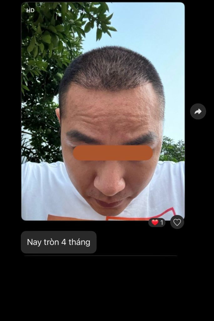 hùng anh đào sau cấy tóc chữa hói đầu thành công