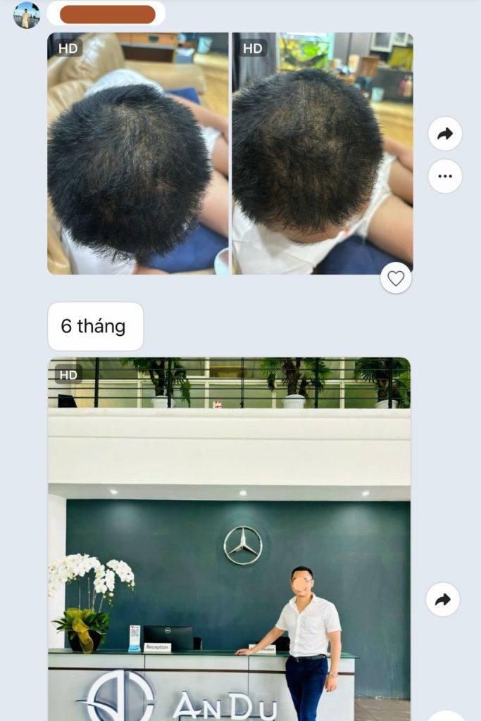 hùng anh đào sau cấy tóc chữa hói đầu thành công