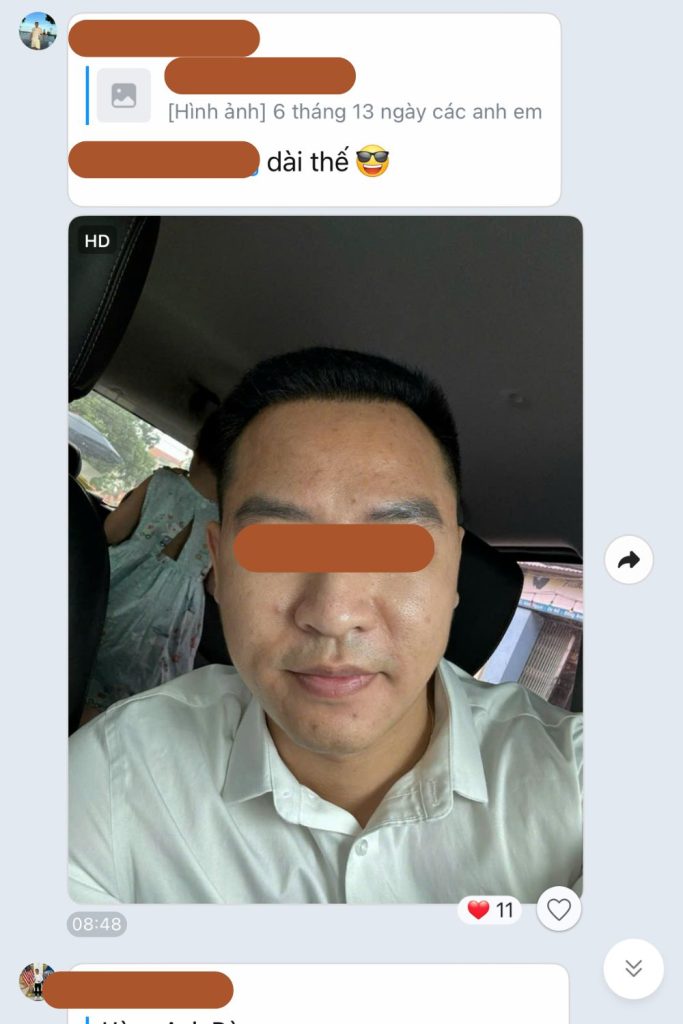 hùng anh đào sau cấy tóc chữa hói đầu thành công