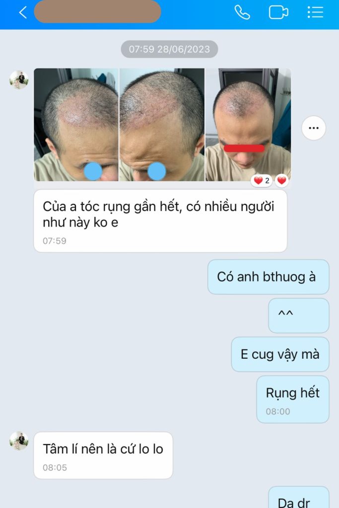 ngô quang hiệp sau cấy tóc chữa hói đầu M thành công - cậu bé thoát hói