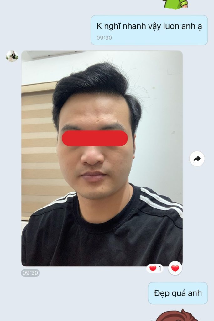 ngô quang hiệp sau cấy tóc chữa hói đầu M thành công - cậu bé thoát hói