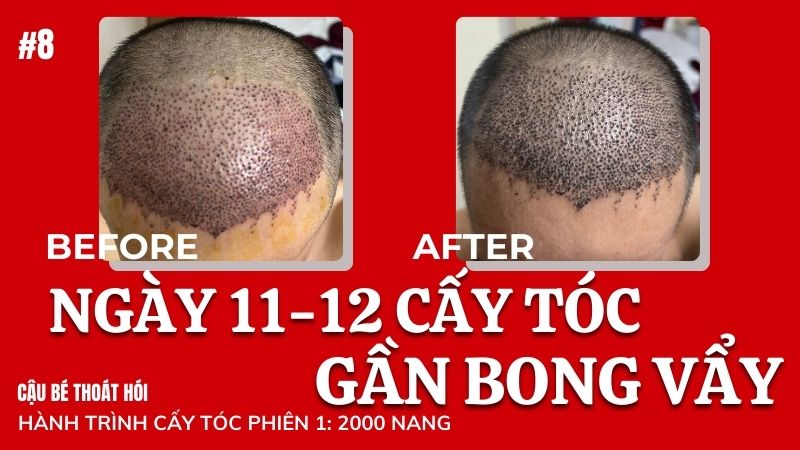 Ngày thứ 11-12 cấy tóc DHI chữa hói khi nào bong vẩy? #8 l Hành Trình Cấy Tóc