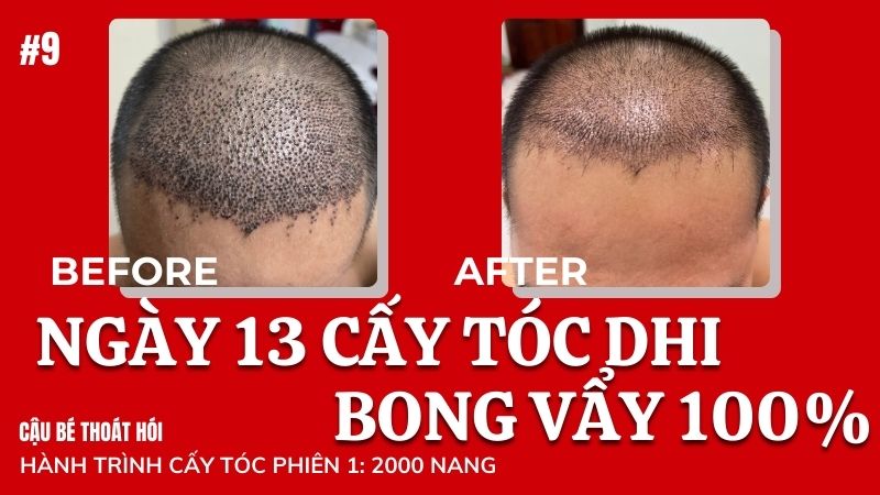 Ngày thứ 13 cấy tóc DHI chữa hói bong vẩy thành công? #9 l Hành Trình Cấy Tóc